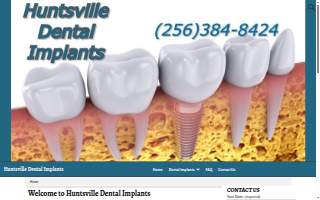 Huntsville Dental Implants website